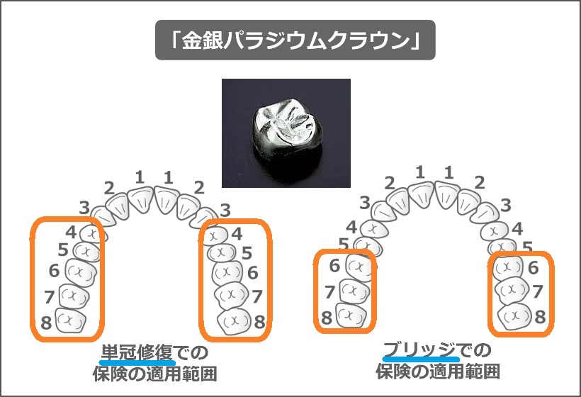 金銀パラジウムクラウンの適用範囲