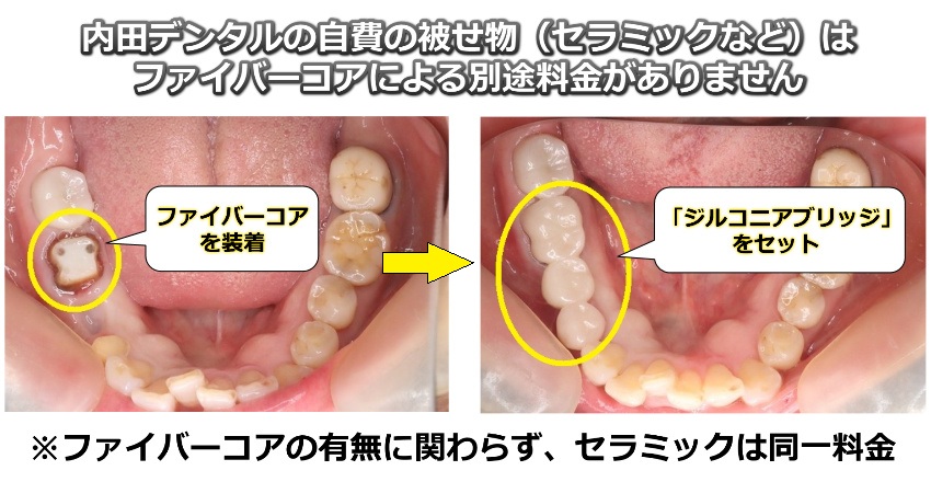 ファイバーコアを装着したジルコニアブリッジ