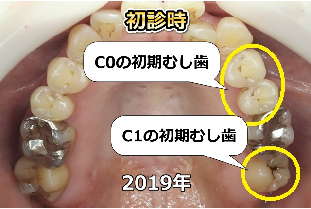 上顎臼歯部のC0、C1（初診時）