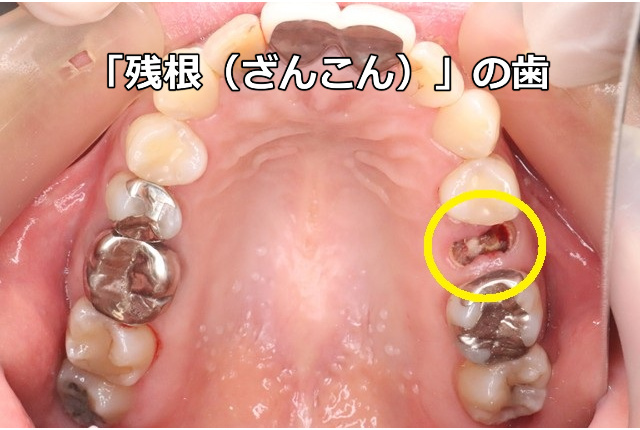 残根の歯