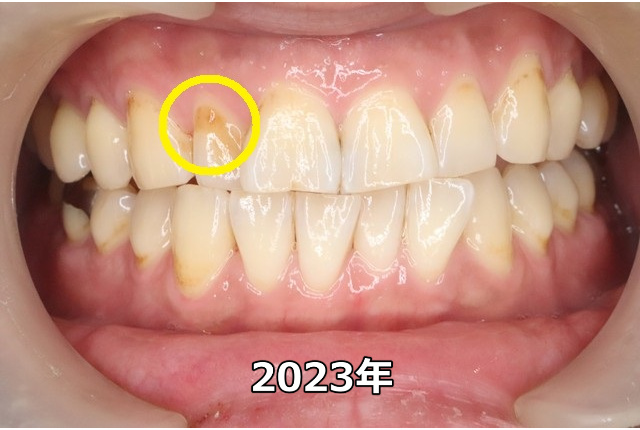 上顎前歯部のCO（2023年）