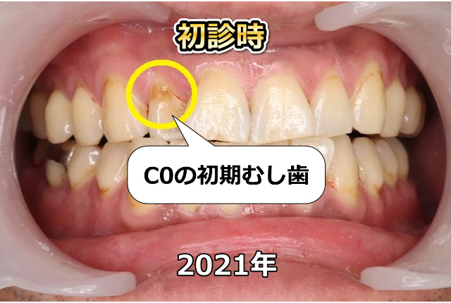 上顎前歯部のCO（初診時）
