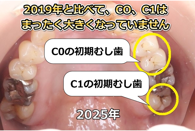 上顎臼歯部のC0、C1（2025年）