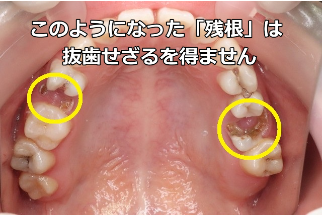 残根の歯（2本）
