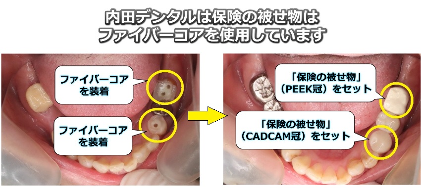 ファイバーコアを装着した写真（保険の被せ物）