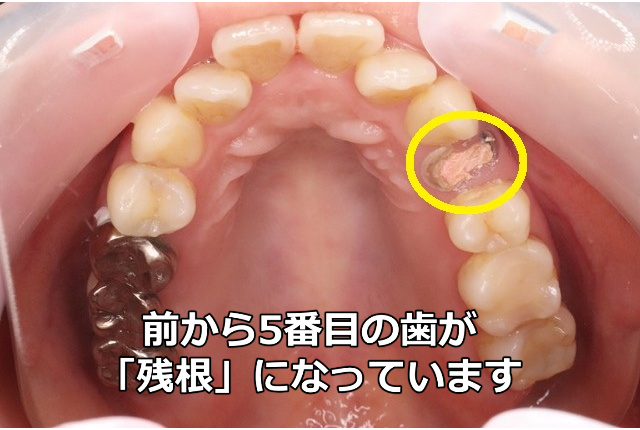 小臼歯の残根