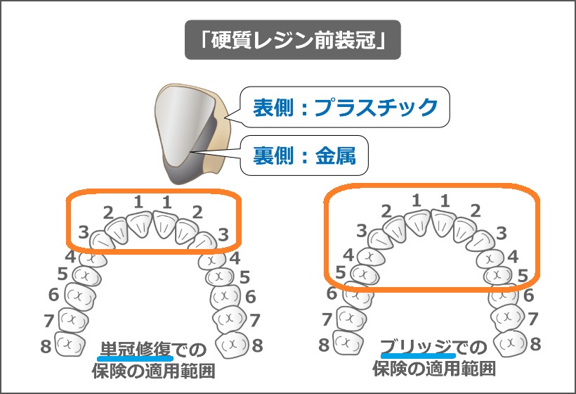 硬質レジン前装冠の適用範囲