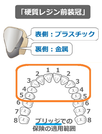 ブリッジでの硬質レジン前装冠の適用範囲