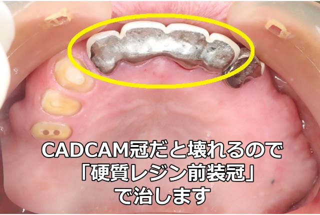 装着した4本連結の硬質レジン前装冠