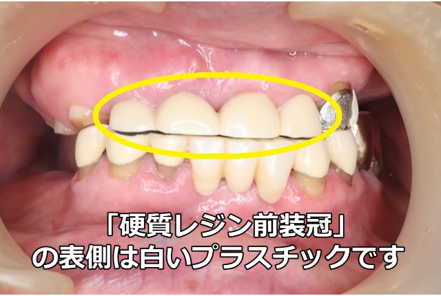 前から見た4本連結の硬質レジン前装冠