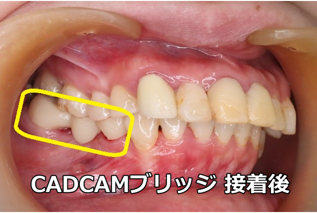 CADCAMブリッジ接着後(頬側面)