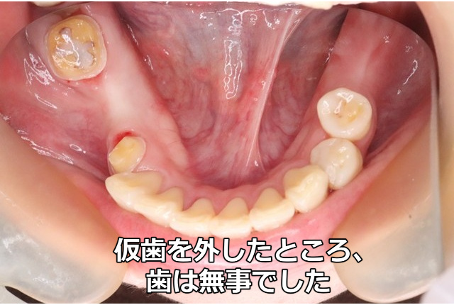 ブリッジの仮歯を外した状態