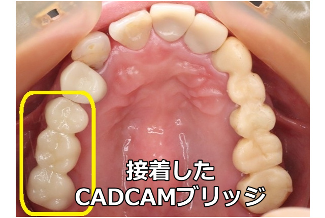 接着したCADCAMブリッジ