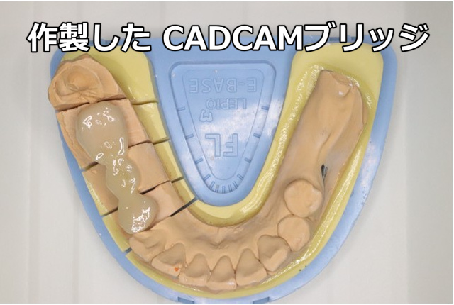 作製したCADCAMブリッジ