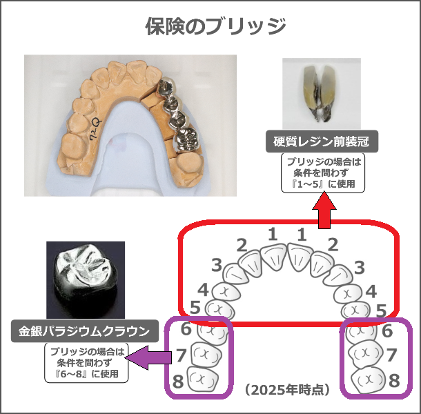 保険のブリッジの適用範囲