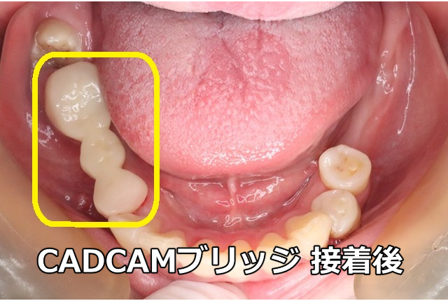 CADCAMブリッジ接着後(咬合面)