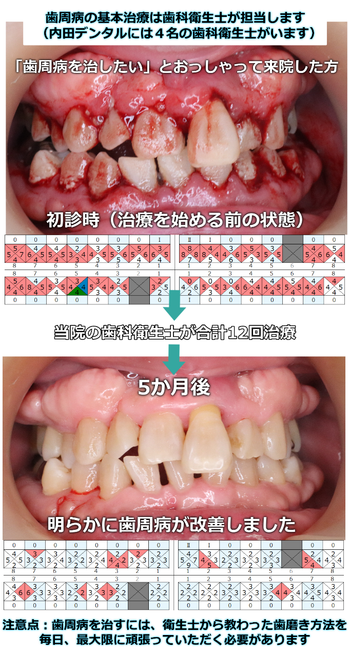 「歯周病を治したい」とおっしゃって来院した方