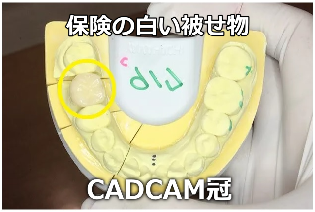 保険の白い被せ物「CADCAM冠」