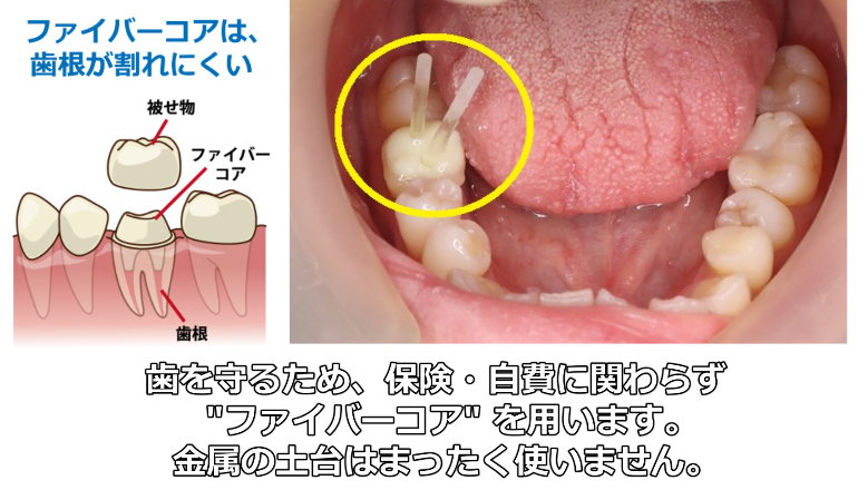 ファイバーコアの説明
