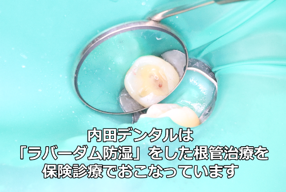 根管治療とラバーダム（露髄した歯）