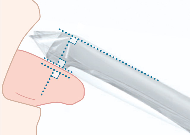 ムーカスを舌に当てている図