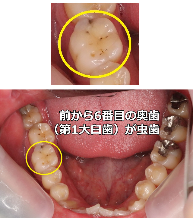 奥歯の虫歯