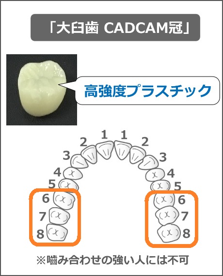 大臼歯CADCAM冠