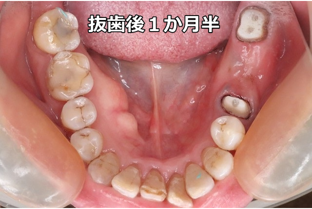 抜歯後1か月半の口腔内写真