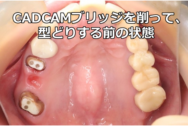 CADCAMブリッジを削って型どりする前の状態