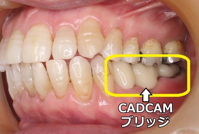 頬側から見たCADCAMブリッジ