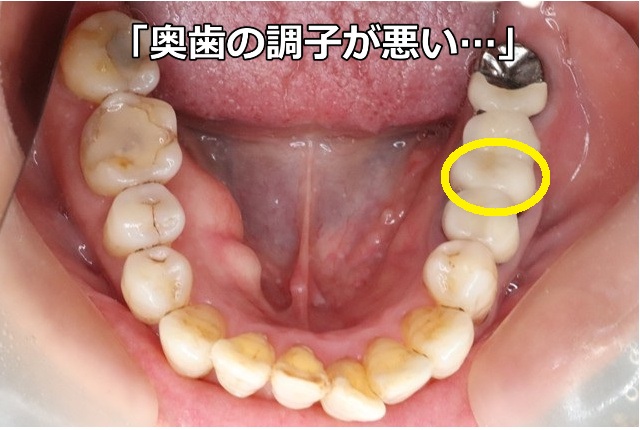 左下奥歯の調子が悪い…