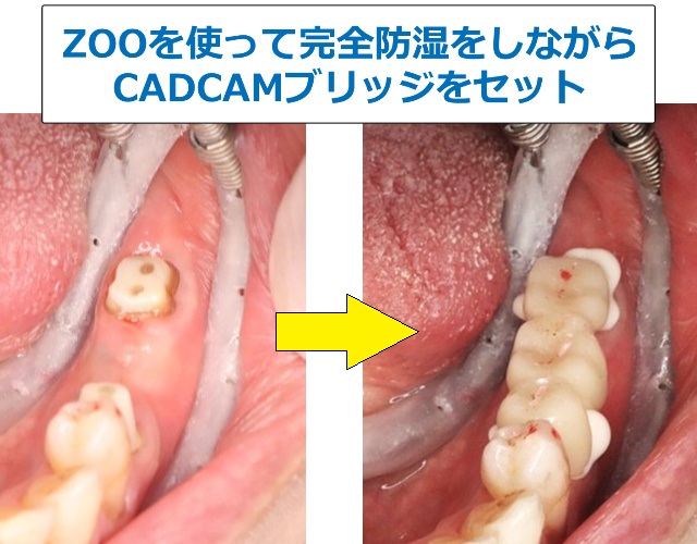 ZOOで防湿した状態でセットしたCADCAMブリッジ