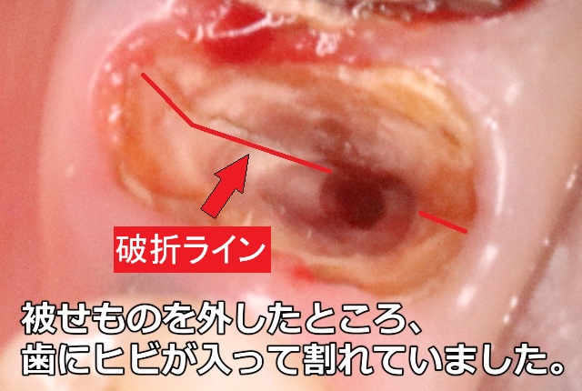 歯根破折のライン