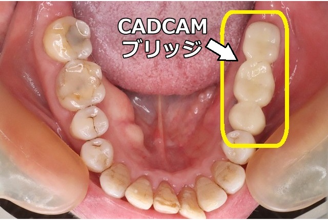 左下奥歯にセットしたCADCAMブリッジ