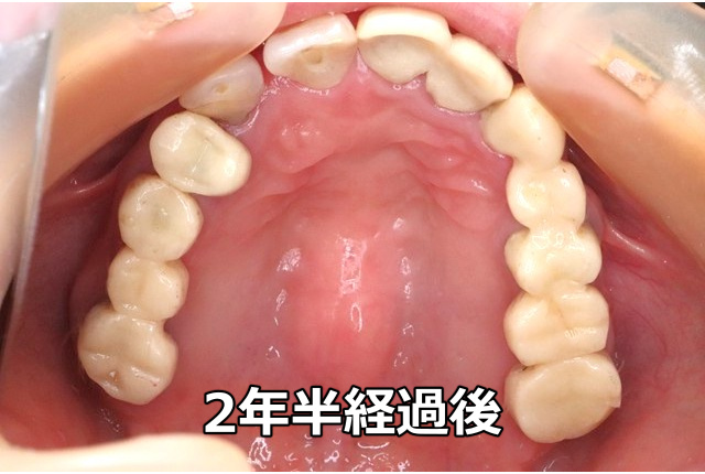 初診から2年半経過してTEKに置き換わった状態