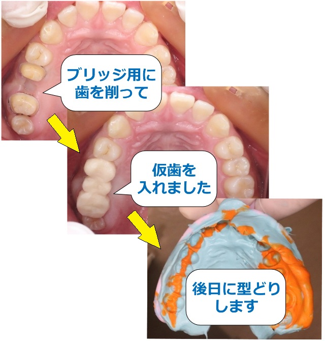 ブリッジ用に削る⇒仮歯⇒型どり