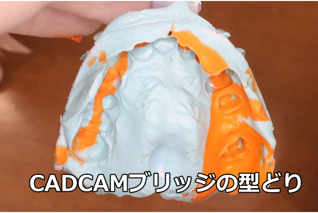 CADCAMブリッジの型どり(シリコン印象)