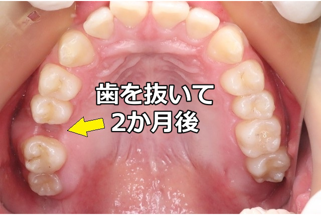 抜歯後2か月の治癒状態