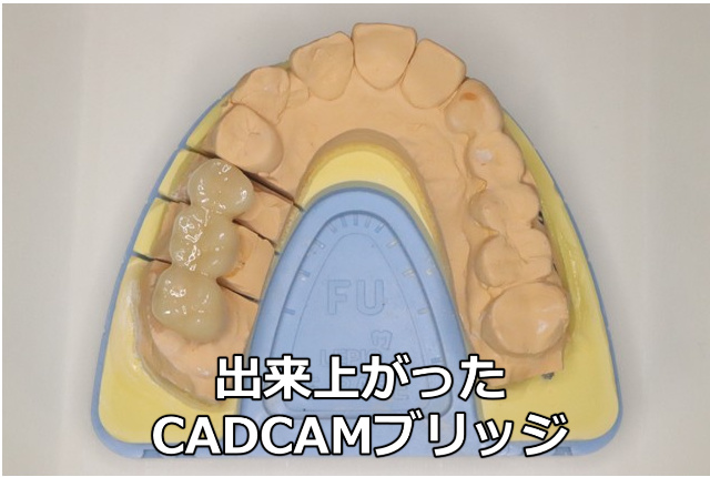 出来上がったCADCAMブリッジ