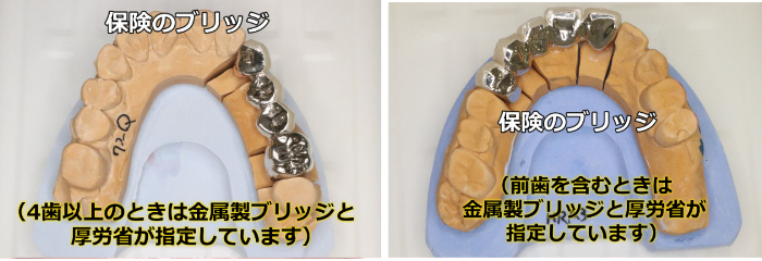 保険の金属製ブリッジの写真
