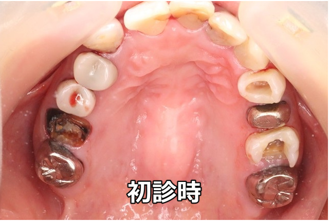 カリエス多数の初診時口腔内写真