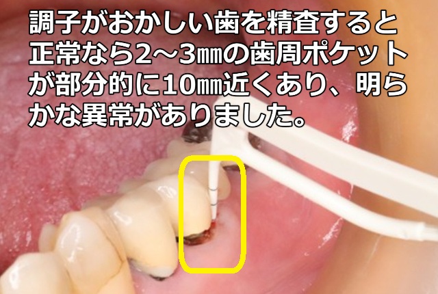 歯周ポケットが10㎜近くある状態