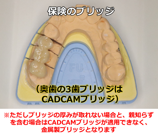 奥歯の3本ブリッジはCADCAMブリッジ