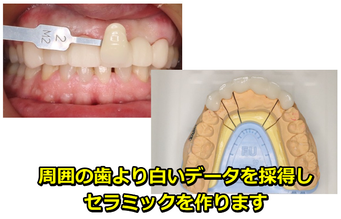 周囲の歯より白いデータを採得し、セラミックを作ります。