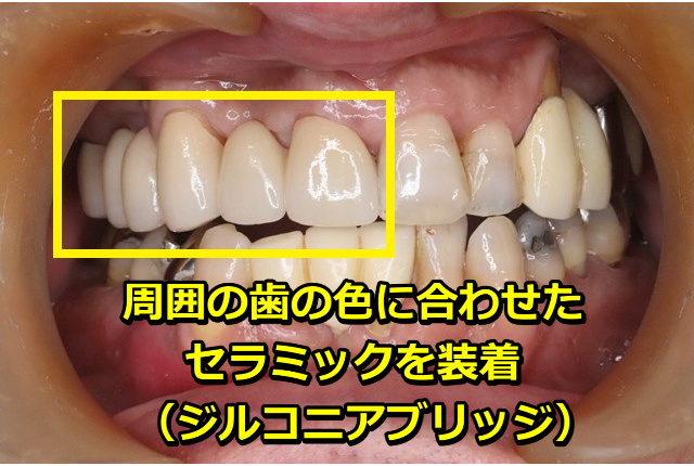 周囲の歯の色に合わせたセラミックを装着(ジルコニアブリッジ)