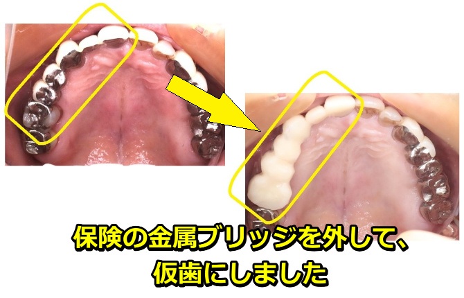 保険の金属ブリッジを外して、仮歯にしました。