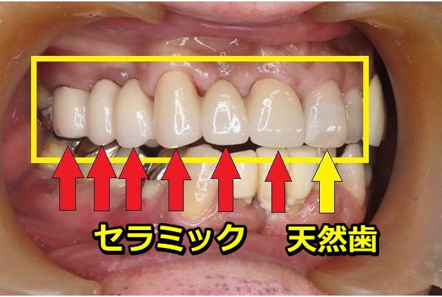 側方が見たジルコニアブリッジ