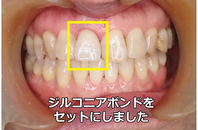 セットしたジルコニアボンド