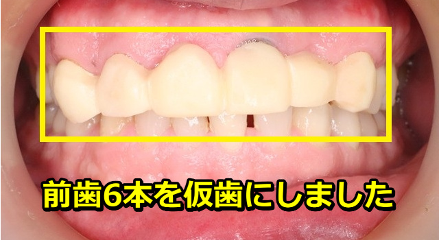 前歯6本を仮歯にしました。