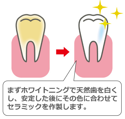 ホワイトニングの前後の歯のイラスト